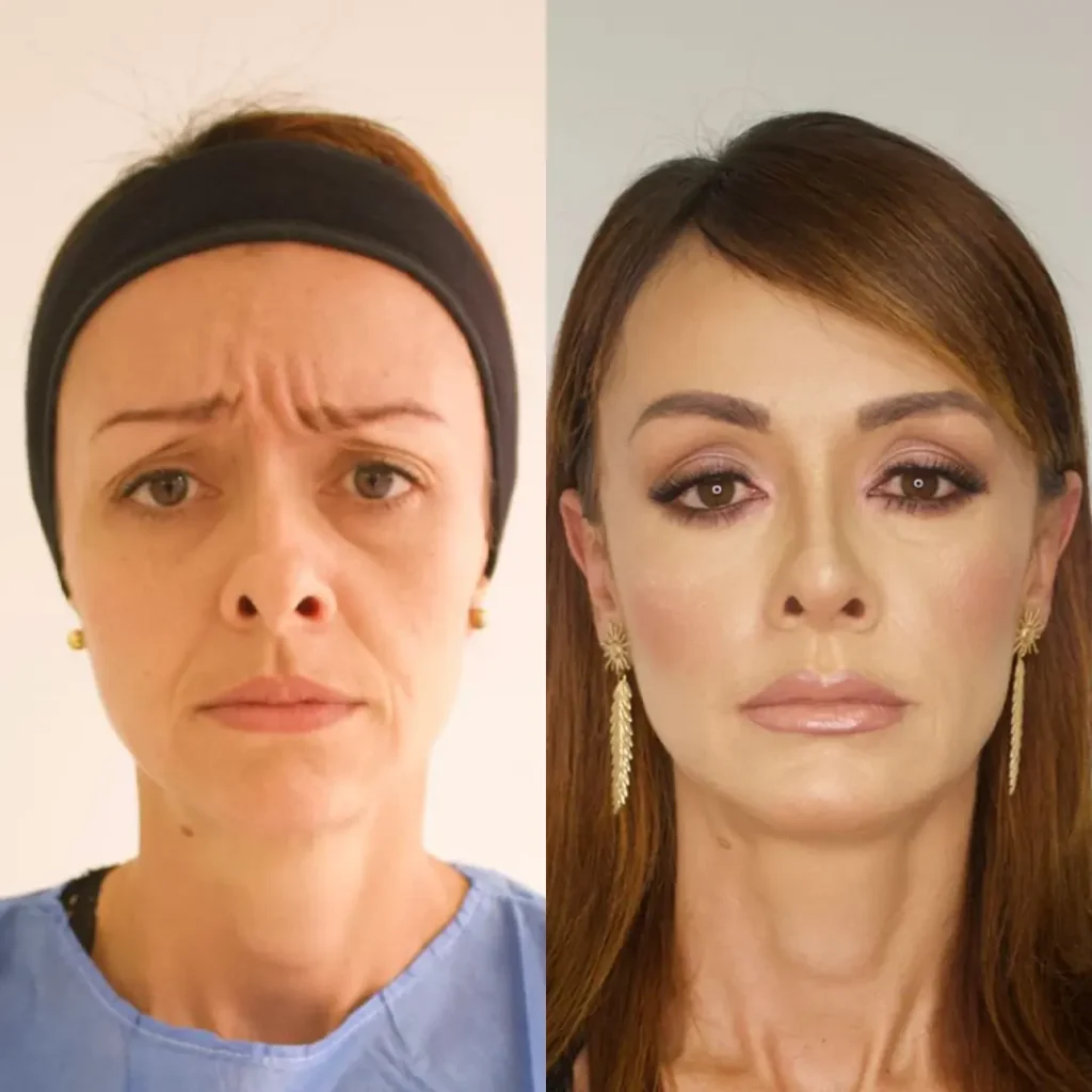 Botox - Grupo Estético CB Colombia