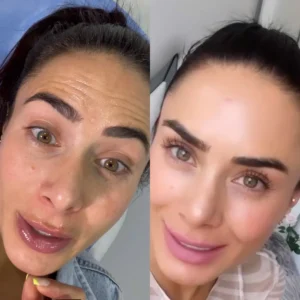 BOTULINUM TOXIN Grupo Estético CB Miami