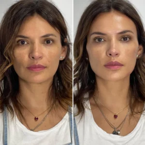 Radiesse - Grupo Estético CB Miami