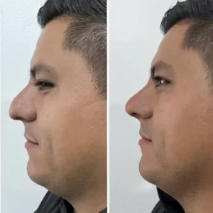 RHINOMODELING - Grupo Estético CB Miami