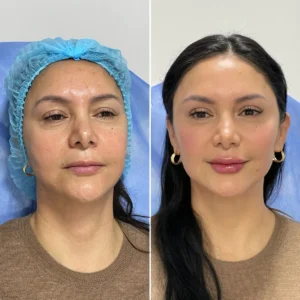 Sculptra - Grupo Estético CB Miami