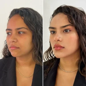 FACIAL HARMONIZATION