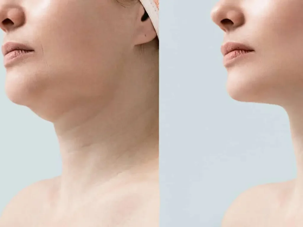 Remove double chin - Grupo Estético CB Miami