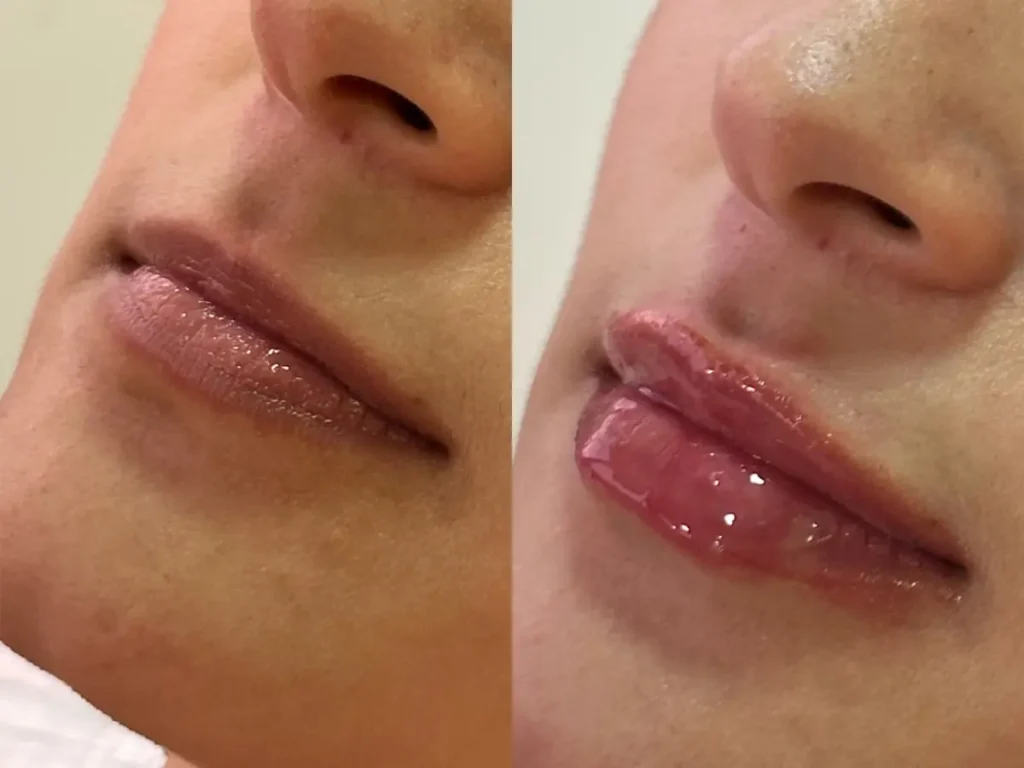 Lips design - MedSpa Grupo Estético CB Miami