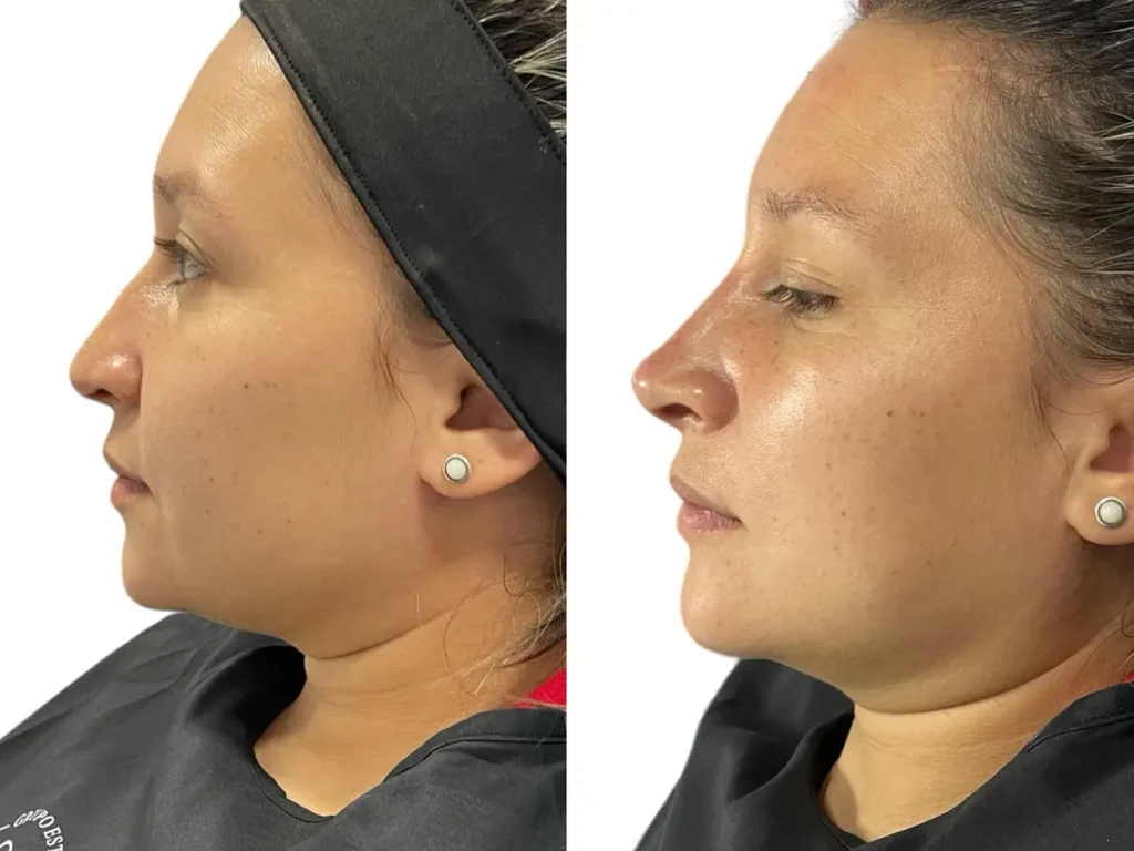 Rhinomodeling without surgery - MedSpa Grupo Estético CB Miami