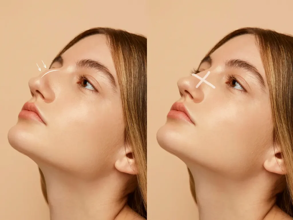 Rhinomodeling without surgery - MedSpa Grupo Estético CB Miami